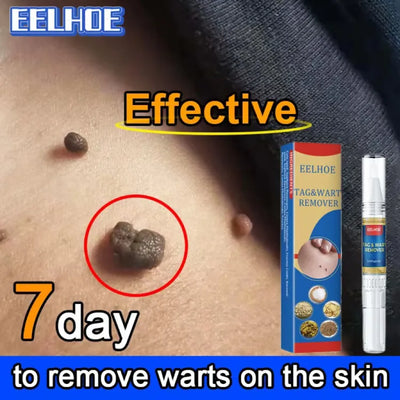 Skin Tag Wart Mole Remover Pen