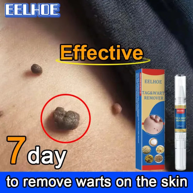 Skin Tag Wart Mole Remover Pen